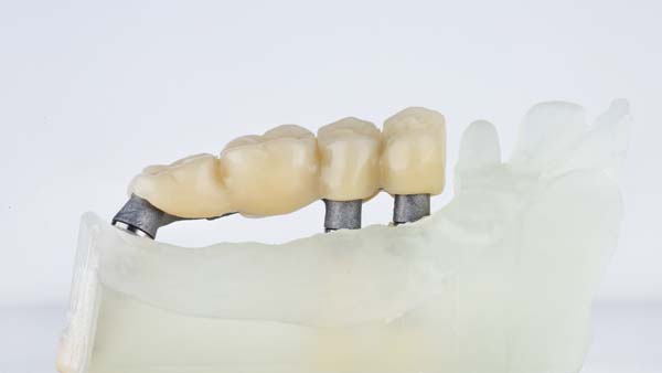 When A Dental Bridge May Be Recommended